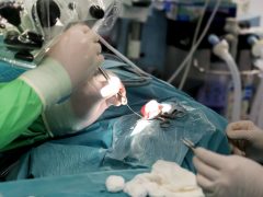 Szeged, okos cochleáris implantátum beültetés, műtét, Szegedi Tudományegyetem, SZTE, Fül- Orr- Gégészeti és Fej- Nyaksebészeti Klinik, hallókészülék, műtő, klinika, egészségügy